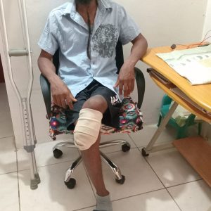 Help Roderick Walk Again with a Prosthetic Leg